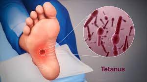 Tetanus – Symptome, Ursachen und Behandlung