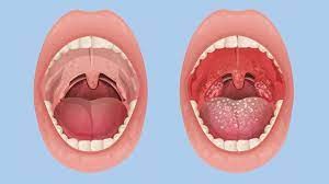 Tonsillitis - Causes, Preventions and Treatments