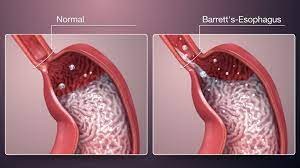 Barrett's Esophagus - Maximed Turkey