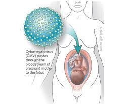 Cytomegalovirus (CMV)-Infektion - Maximierte Türkei