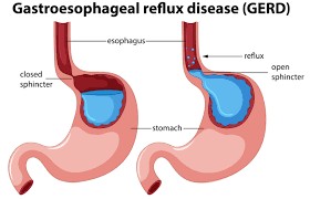 Gastroesophageal Reflux Disease Treatment