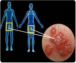 Herpes genitalis – Symptome, Diagnose und Behandlung