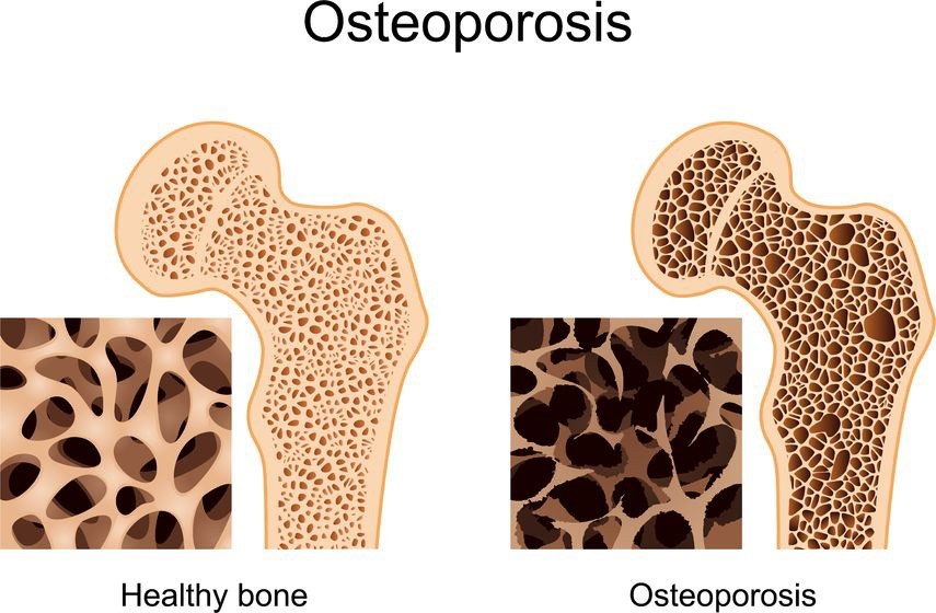 Osteoporosis - Symptoms and Treatments