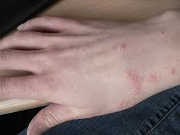 Scabies - Symptoms and Treatment