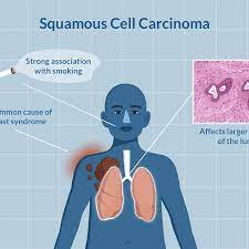 Squamous Cell Carcinoma - Causes and Treatment